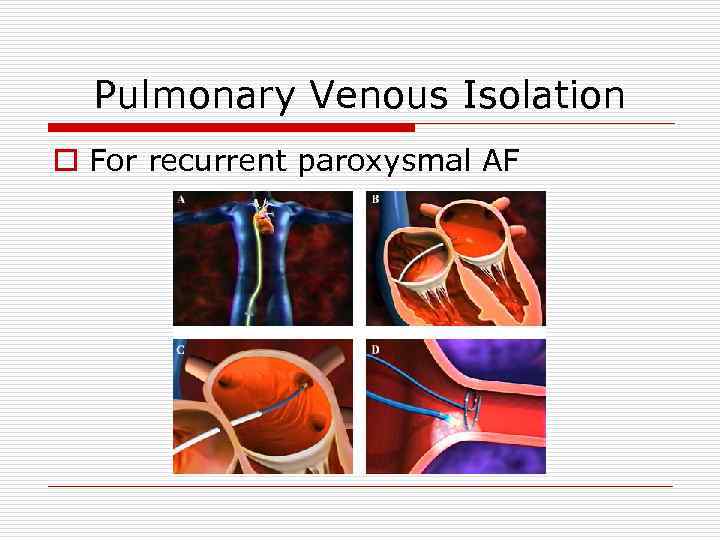 Pulmonary Venous Isolation o For recurrent paroxysmal AF 