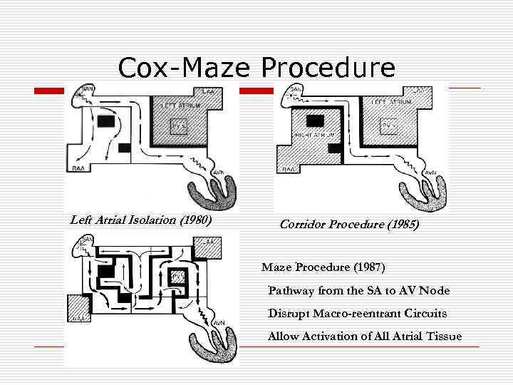 Cox-Maze Procedure Left Atrial Isolation (1980) Corridor Procedure (1985) Maze Procedure (1987) Pathway from