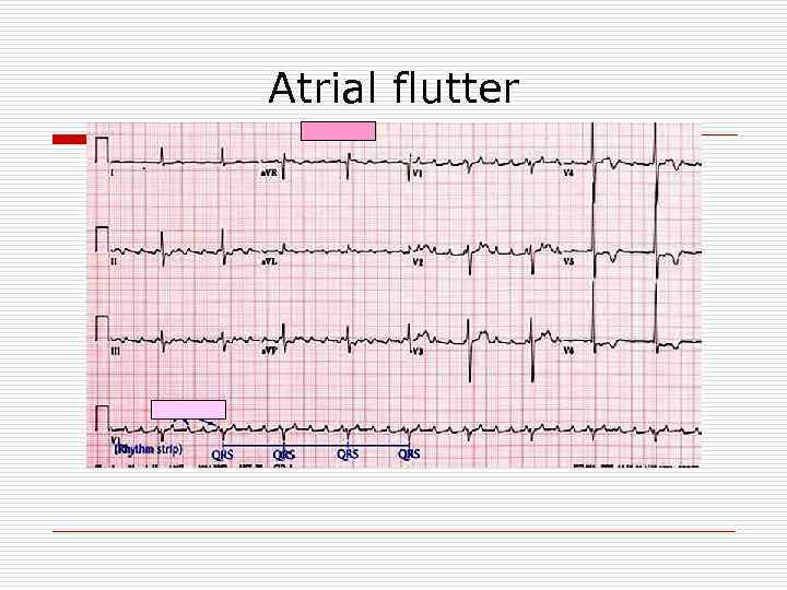 Atrial flutter 