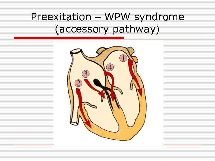 Preexitation – WPW syndrome (accessory pathway) 