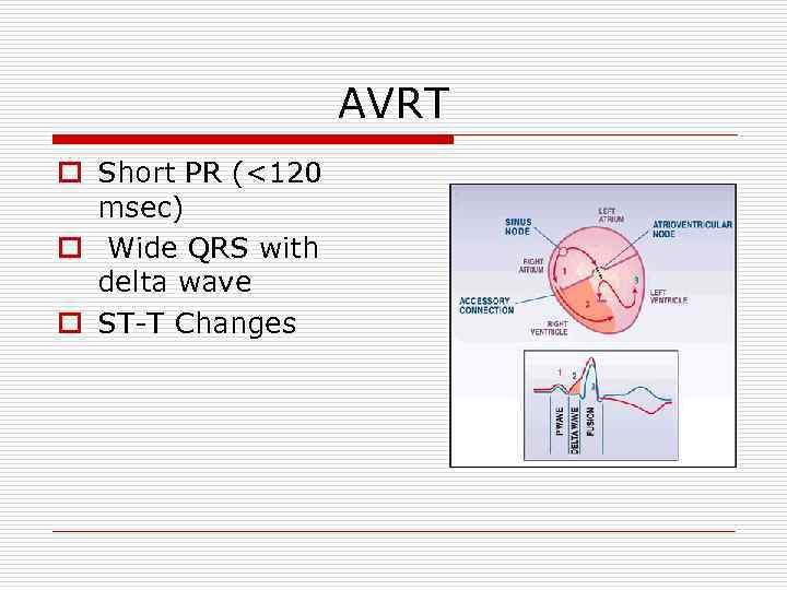 AVRT o Short PR (<120 msec) o Wide QRS with delta wave o ST-T