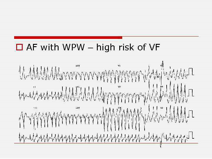o AF with WPW – high risk of VF 