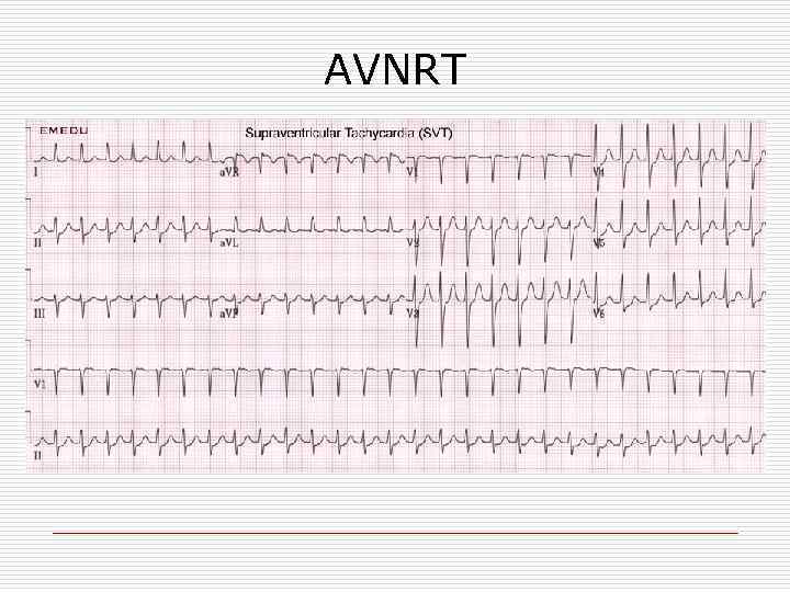 AVNRT 