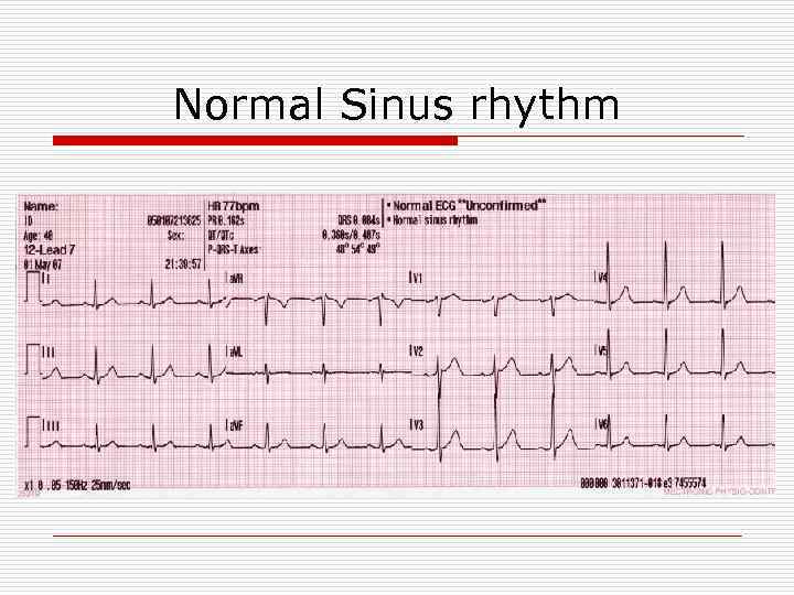Normal Sinus rhythm 
