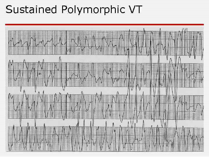 Sustained Polymorphic VT 