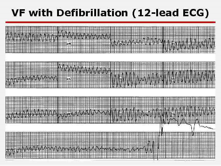 VF with Defibrillation (12 -lead ECG) 