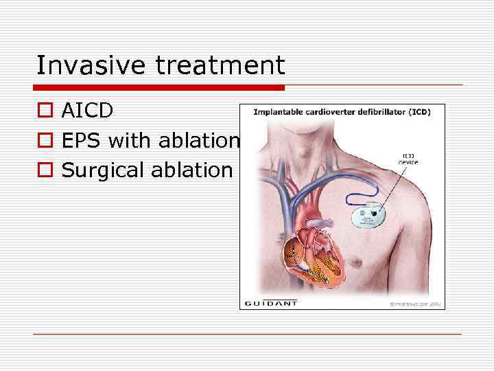 Invasive treatment o AICD o EPS with ablation o Surgical ablation 