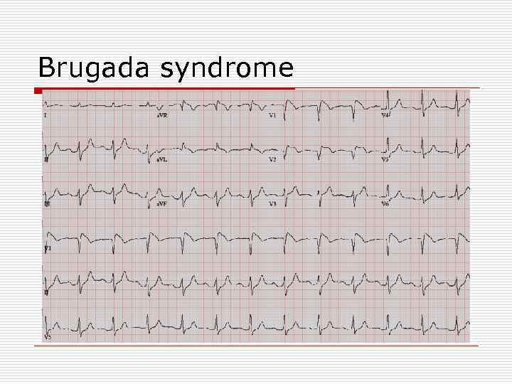 Brugada syndrome 
