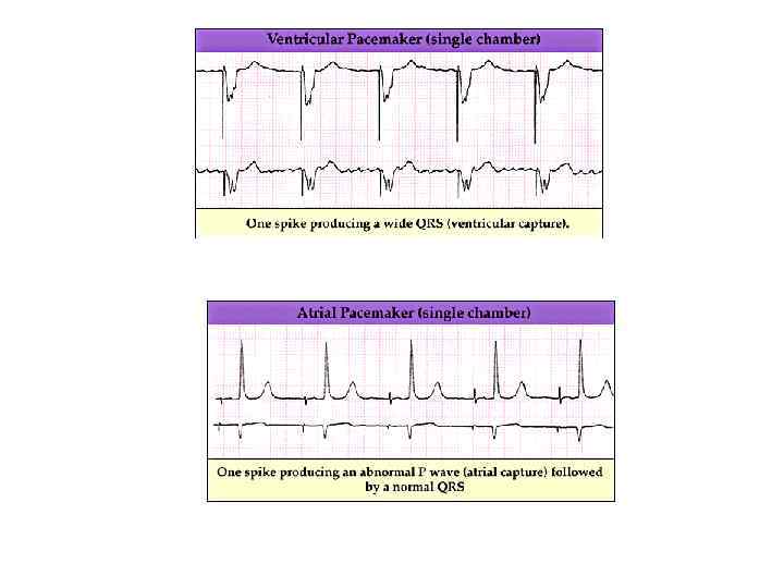 Single-chamber versus dual-chamber pacing for high-grade atrioventricular block