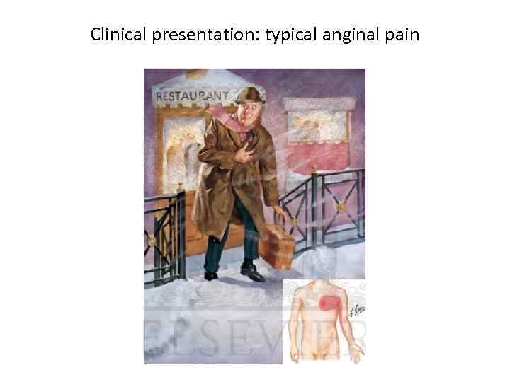 Clinical presentation: typical anginal pain 