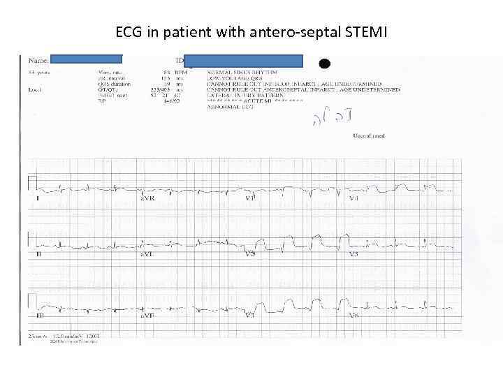 ECG in patient with antero-septal STEMI 