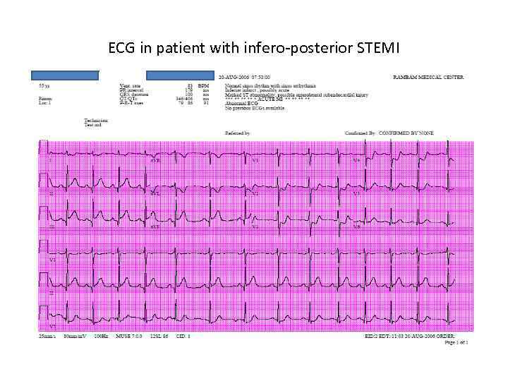 ECG in patient with infero-posterior STEMI 