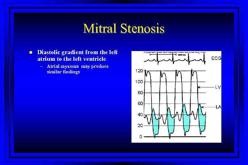 Mitral Stenosis l Diastolic gradient from the left atrium to the left ventricle –