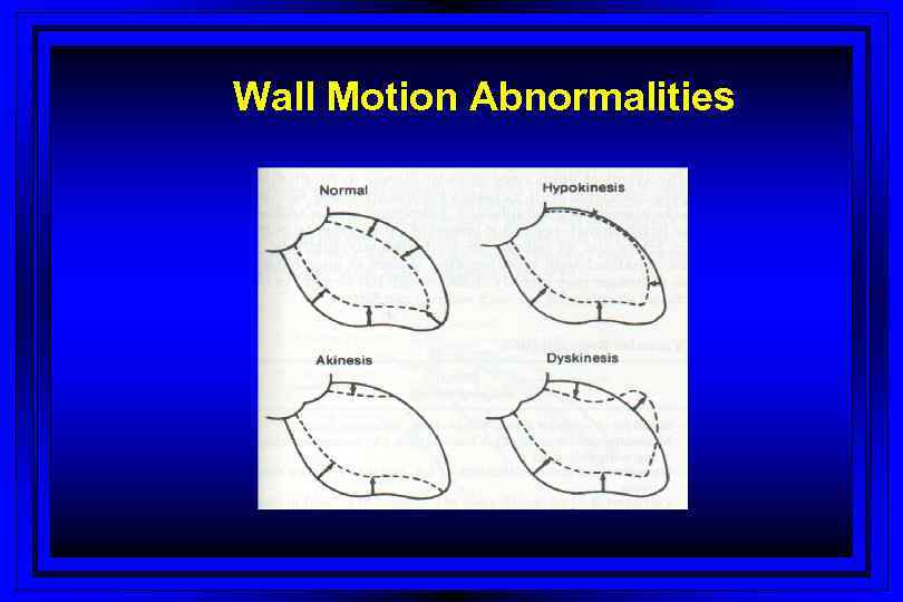 Wall Motion Abnormalities 