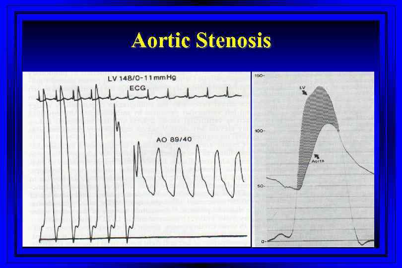 Aortic Stenosis 