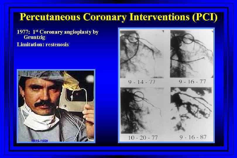 Percutaneous Coronary Interventions (PCI) 1977: 1 st Coronary angioplasty by Gruntzig Limitation: restenosis 1939