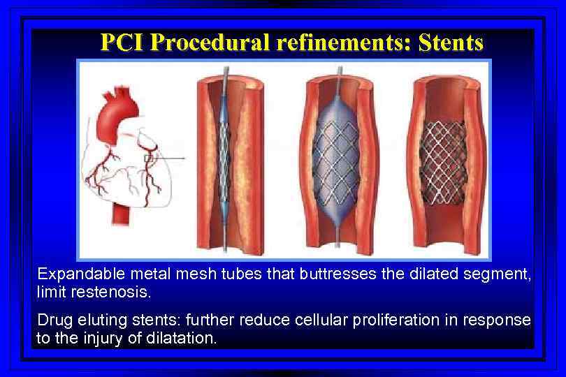 PCI Procedural refinements: Stents Expandable metal mesh tubes that buttresses the dilated segment, limit