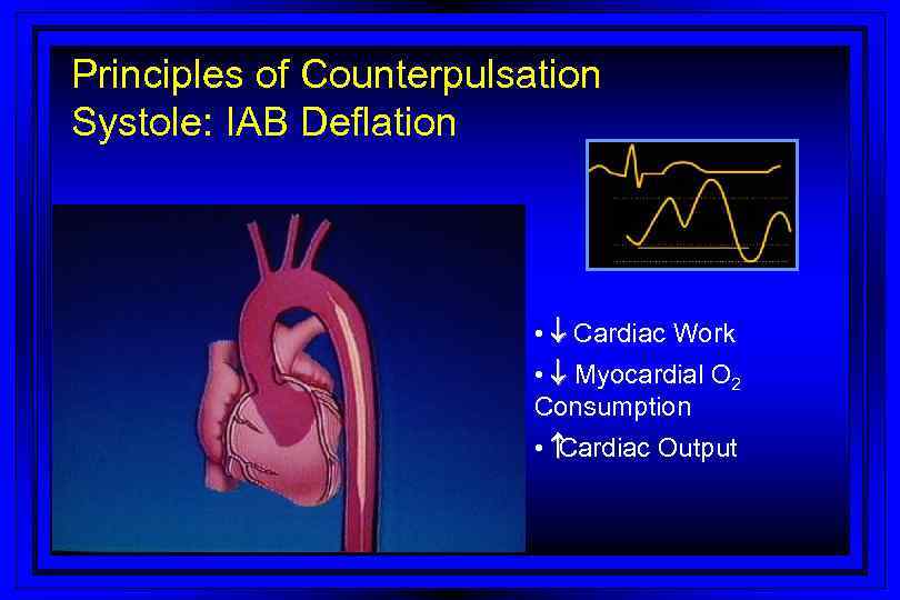 Principles of Counterpulsation Systole: IAB Deflation • ¯ Cardiac Work • ¯ Myocardial O