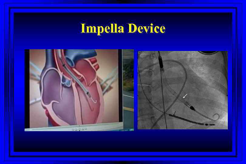 Impella Device 