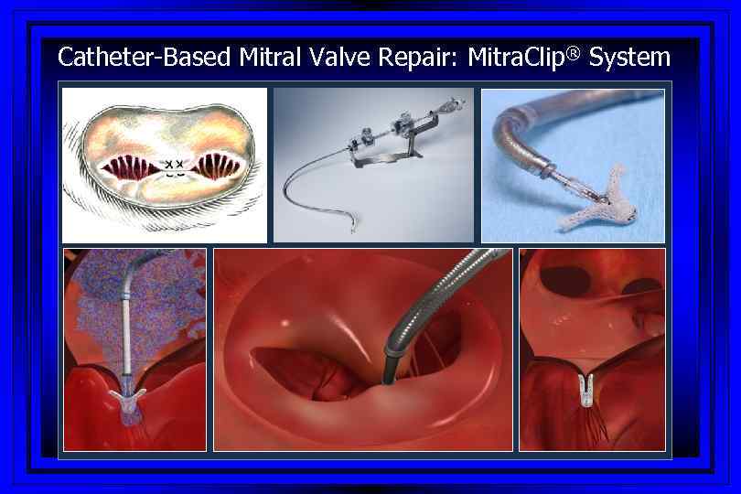 Catheter-Based Mitral Valve Repair: Mitra. Clip® System 