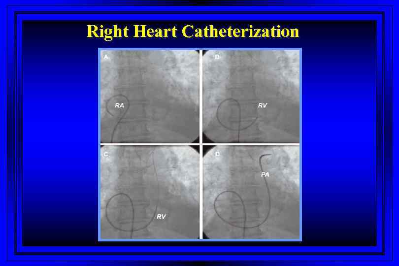 Right Heart Catheterization 