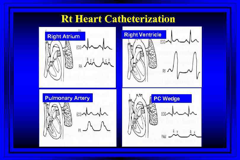 Rt Heart Catheterization Right Atrium Pulmonary Artery Right Ventricle PC Wedge 