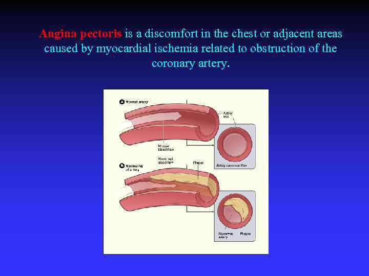 Angina pectoris is a discomfort in the chest or adjacent areas caused by myocardial