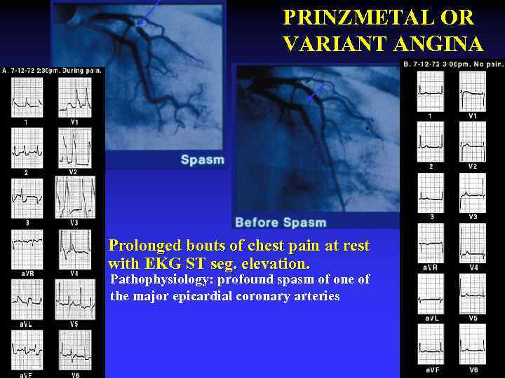 PRINZMETAL OR VARIANT ANGINA Ø Prolonged bouts of chest pain at rest with EKG