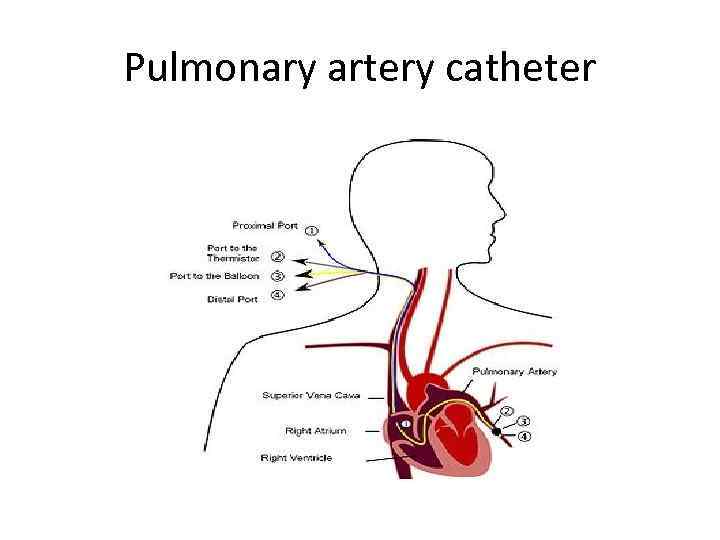 Pulmonary artery catheter 