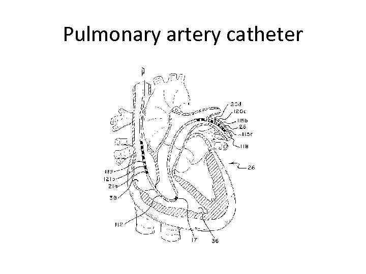 Pulmonary artery catheter 