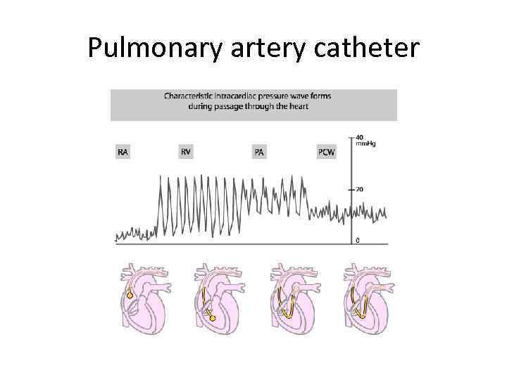 Pulmonary artery catheter 