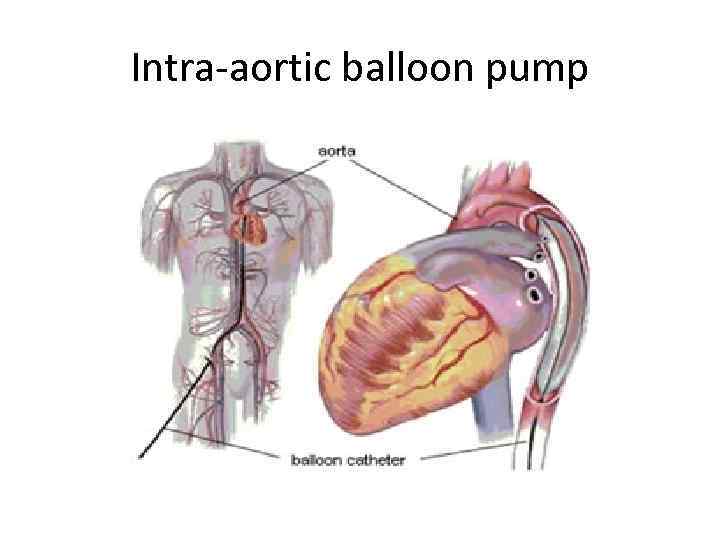 Intra-aortic balloon pump 