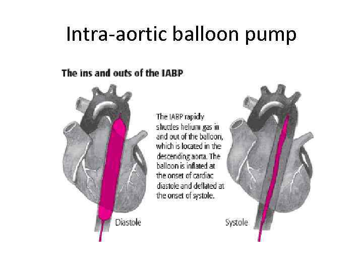 Intra-aortic balloon pump 