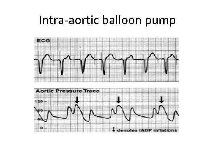 Intra-aortic balloon pump 