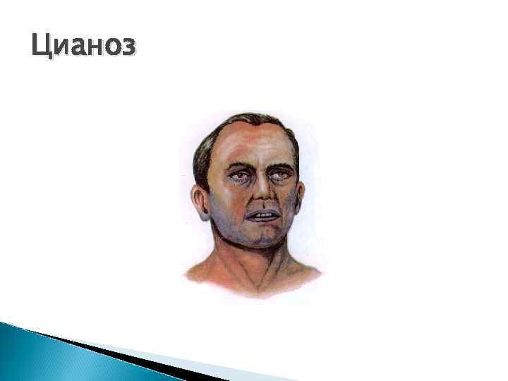 Цианоз 