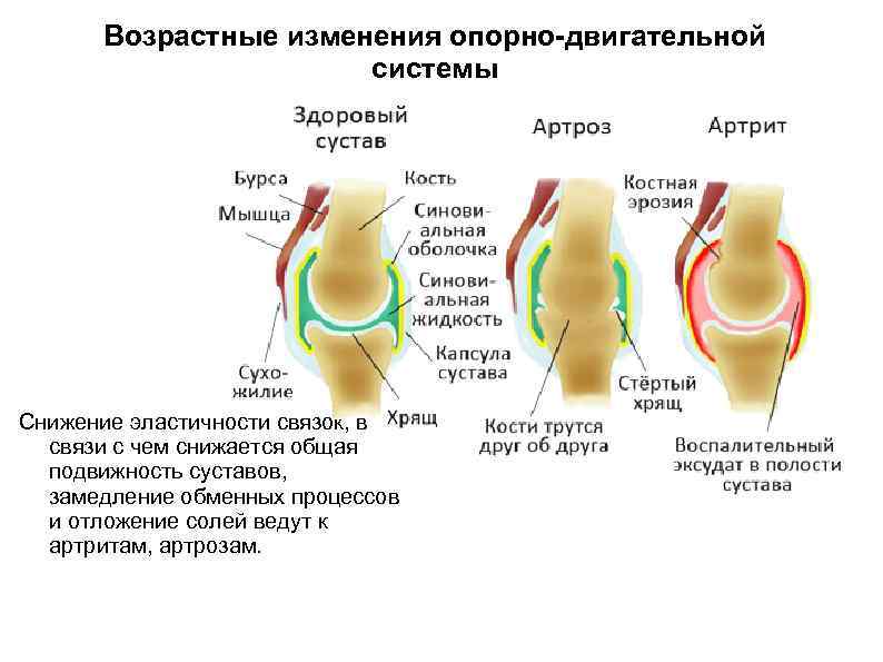 Возрастные изменения опорно-двигательной системы Снижение эластичности связок, в связи с чем снижается общая подвижность