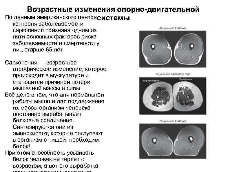 Возрастные изменения опорно-двигательной По данным американского центрасистемы контроля заболеваемости саркопения признана одним из пяти