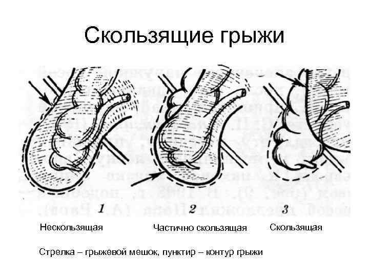 Скользящие грыжи Нескользящая Частично скользящая Стрелка – грыжевой мешок, пунктир – контур грыжи Скользящая