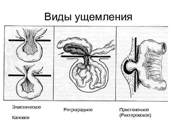 Виды ущемления Эластическое Каловое Ретроградное Пристеночное (Рихтеровское) 