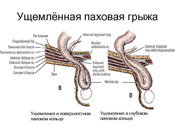 Ущемлённая паховая грыжа Ущемление в поверхностном паховом кольце Ущемление в глубоком паховом кольце 