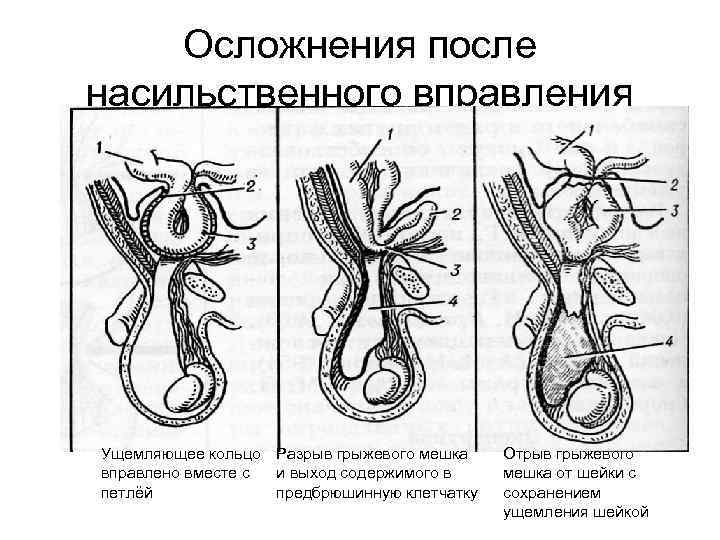 Осложнения после насильственного вправления Ущемляющее кольцо Разрыв грыжевого мешка вправлено вместе с и выход