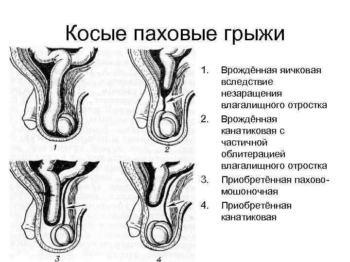 Косые паховые грыжи 1. 2. 3. 4. Врождённая яичковая вследствие незаращения влагалищного отростка Врождённая