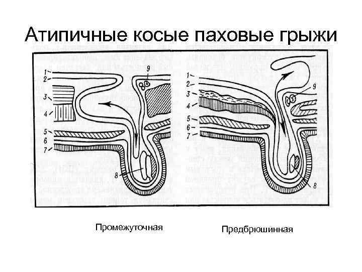 Атипичные косые паховые грыжи Промежуточная Предбрюшинная 