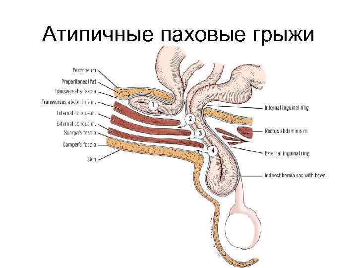 Атипичные паховые грыжи 