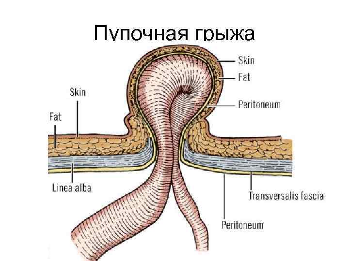 Пупочная грыжа 