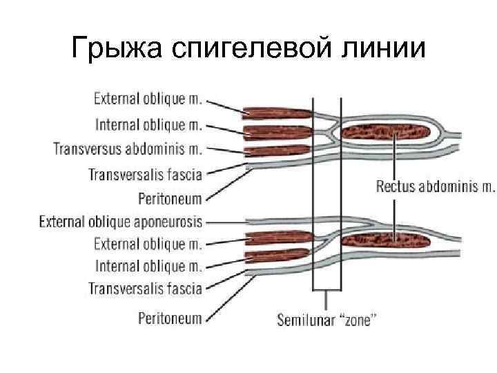 Грыжа спигелевой линии 