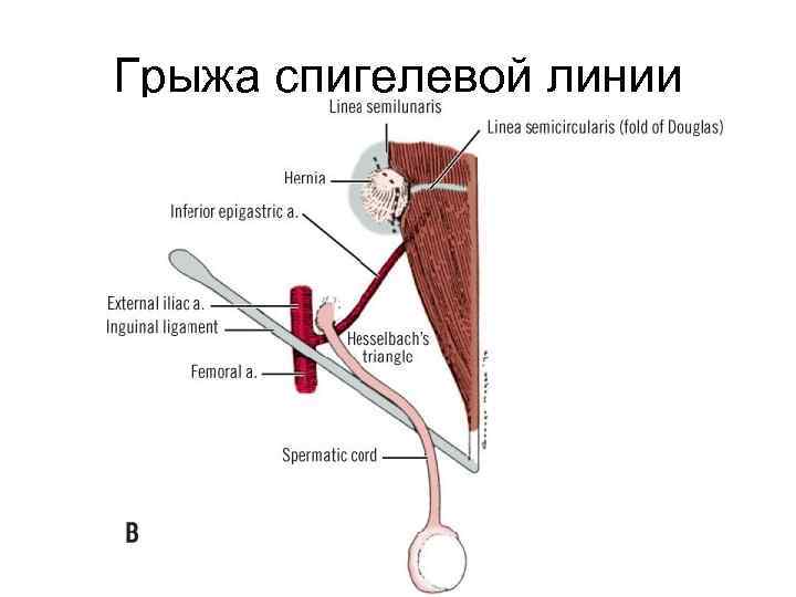 Грыжа спигелевой линии 