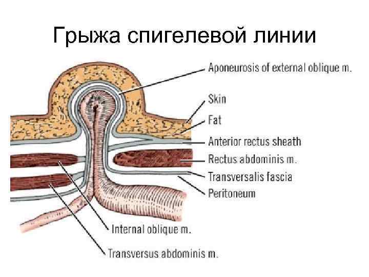 Грыжа спигелевой линии 