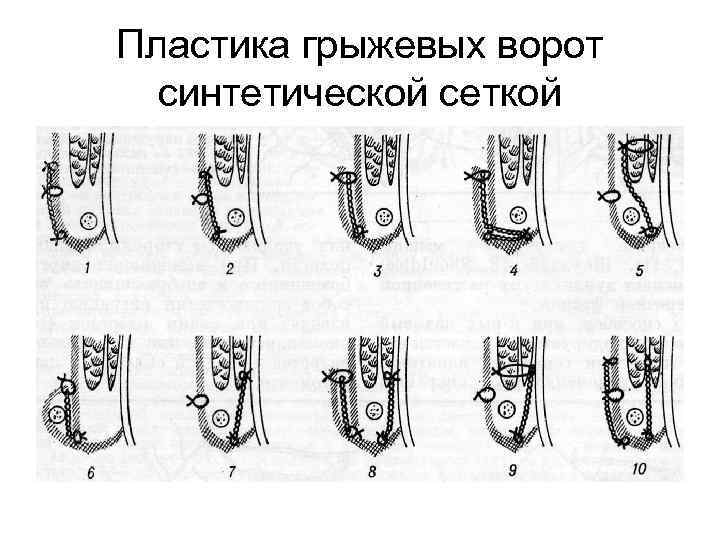 Пластика грыжевых ворот синтетической сеткой 