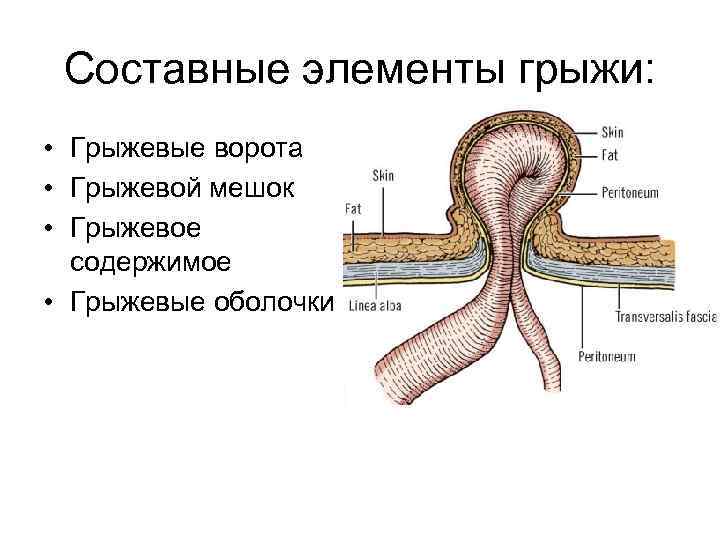 Составные элементы грыжи: • Грыжевые ворота • Грыжевой мешок • Грыжевое содержимое • Грыжевые